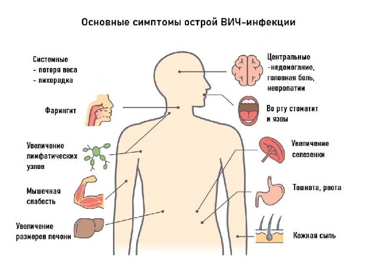 ВИЧ - инфекция